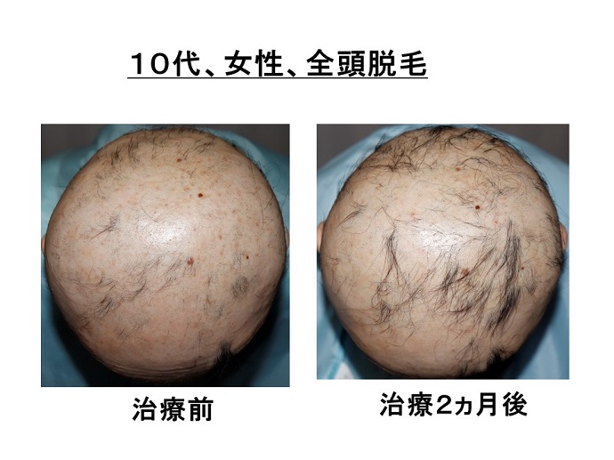 円形脱毛症　病院